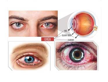 Uveitis